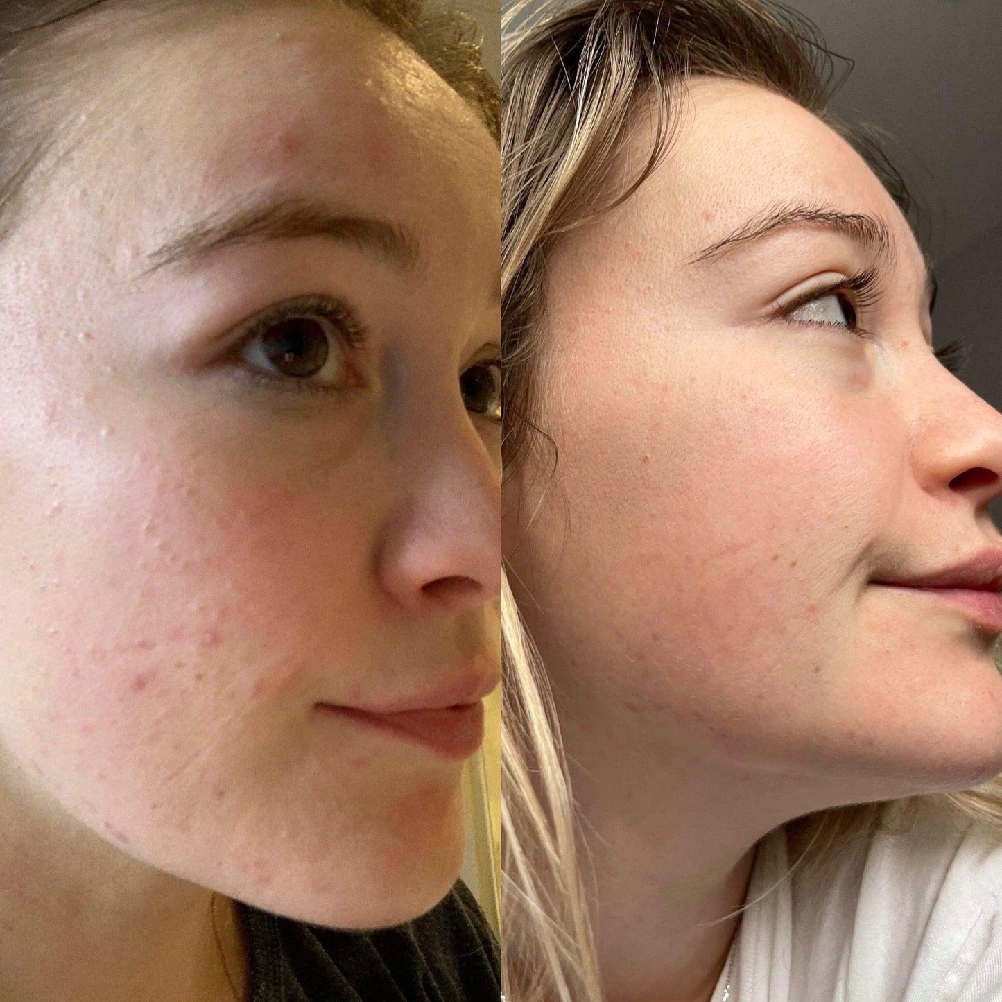 Argan Acne Rehab Serum 30ml | Plant-Based Formula for Acne-Prone Skin-7